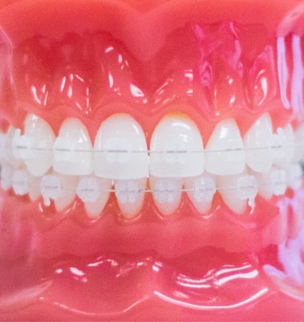 clear braces on plastic model